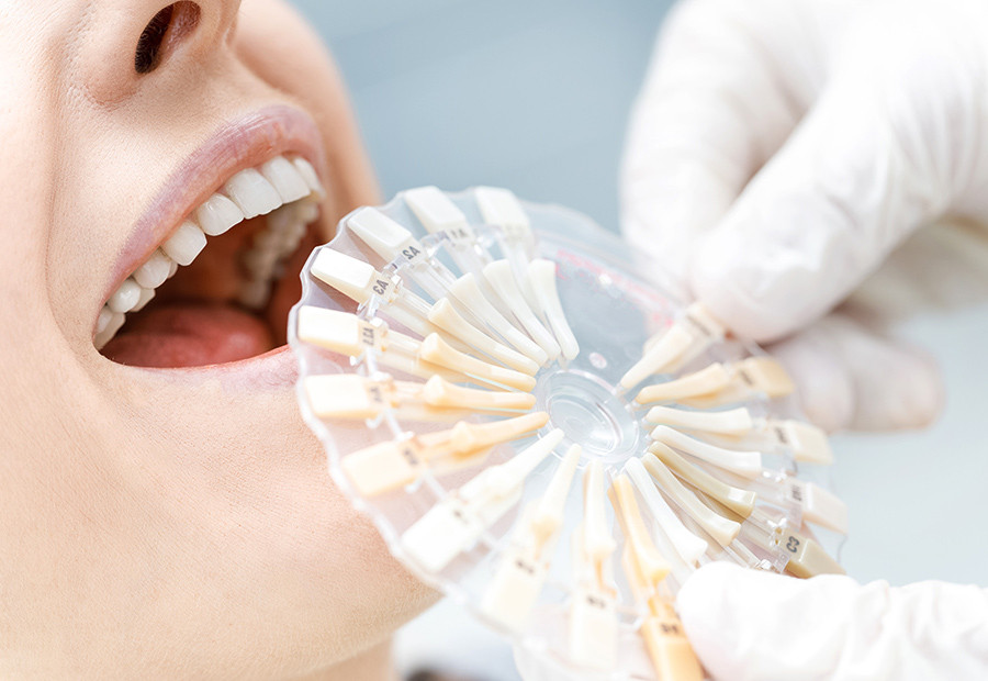 Dental Veneers

